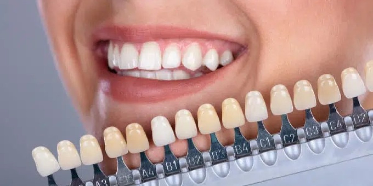 The Role of Emax Veneers in Cosmetic Dentistry Trends