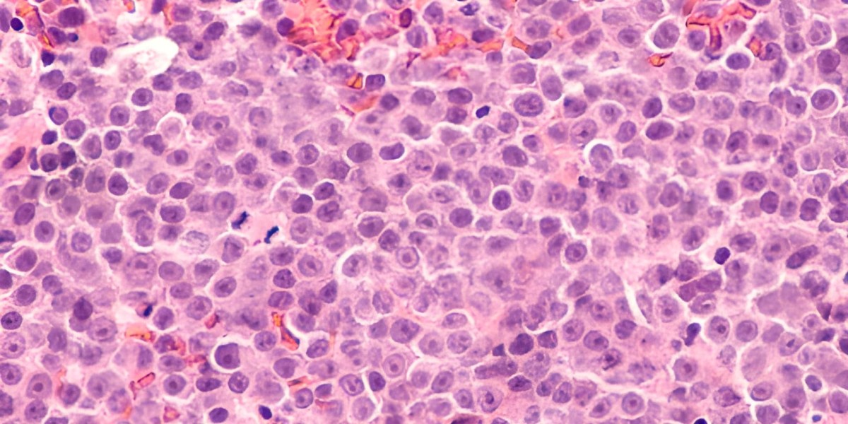 Advancements in Anaplastic Lymphoma Kinase: Market Insights and Therapeutic Opportunities