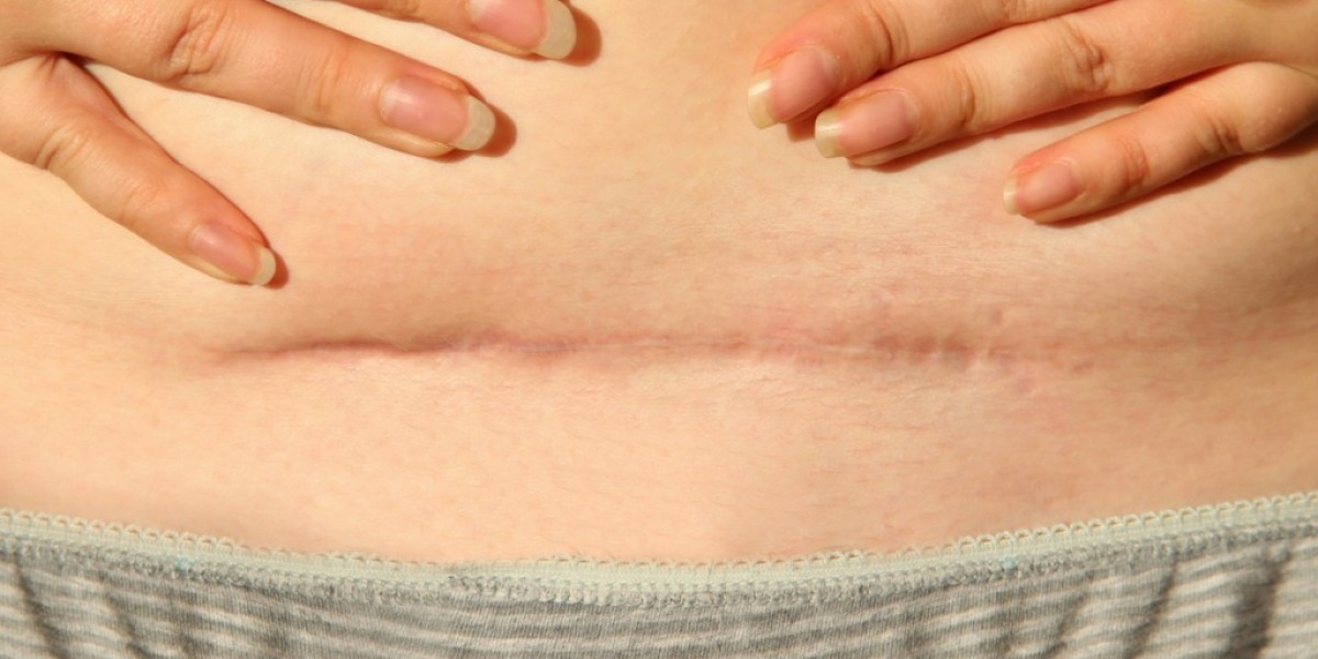 Can a Tummy Tuck Improve Appearance After Multiple Pregnancies?