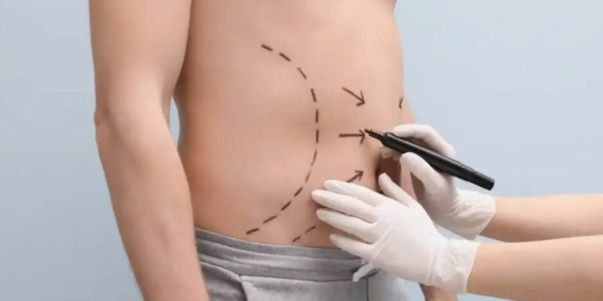 Liposuction for Men in Islamabad: What to Expect
