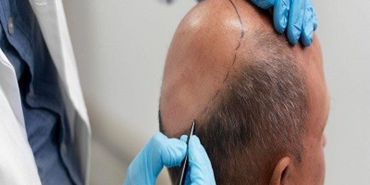How Riyadh is Transforming into a Leading Destination for Top-Quality Hair Transplants