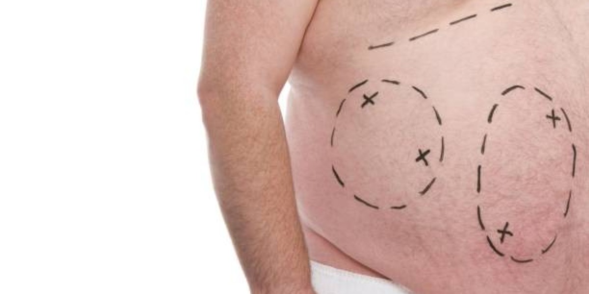 How Lipo Abdominoplasty Addresses Both Fat and Skin