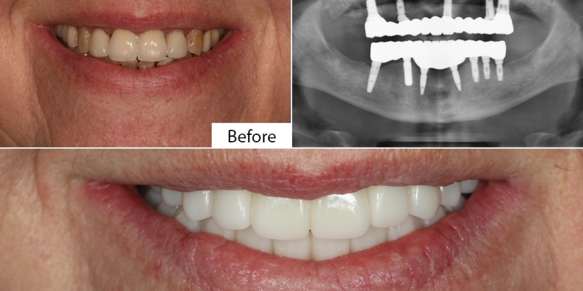 Why Is Jawbone Density Important for Dental Implant in Islamabad?