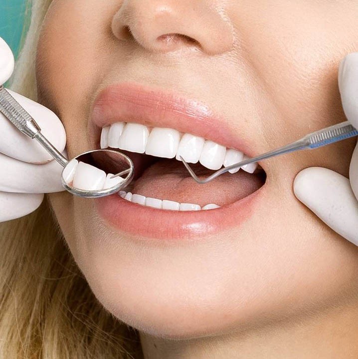 Tooth Filling