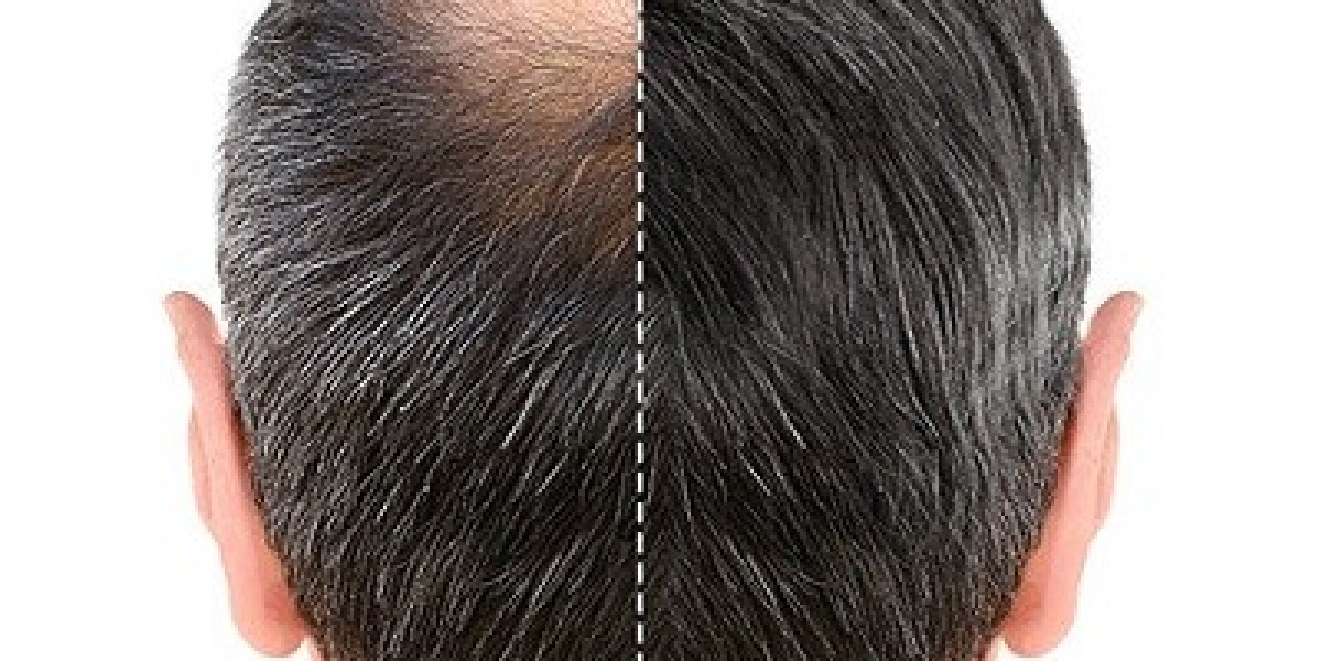 Why Hair Transplant in Dubai is Becoming a Global Trend