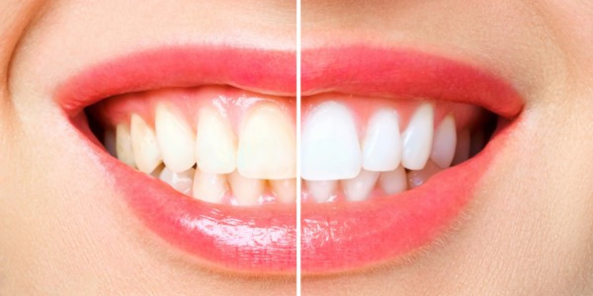 How Long After Using Teeth Whitening Strips Can I Eat? A Complete Guide