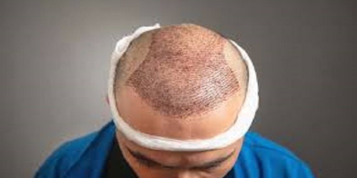 Riyadh Hair Transplants: The Ultimate Guide to Restoring Your Hair