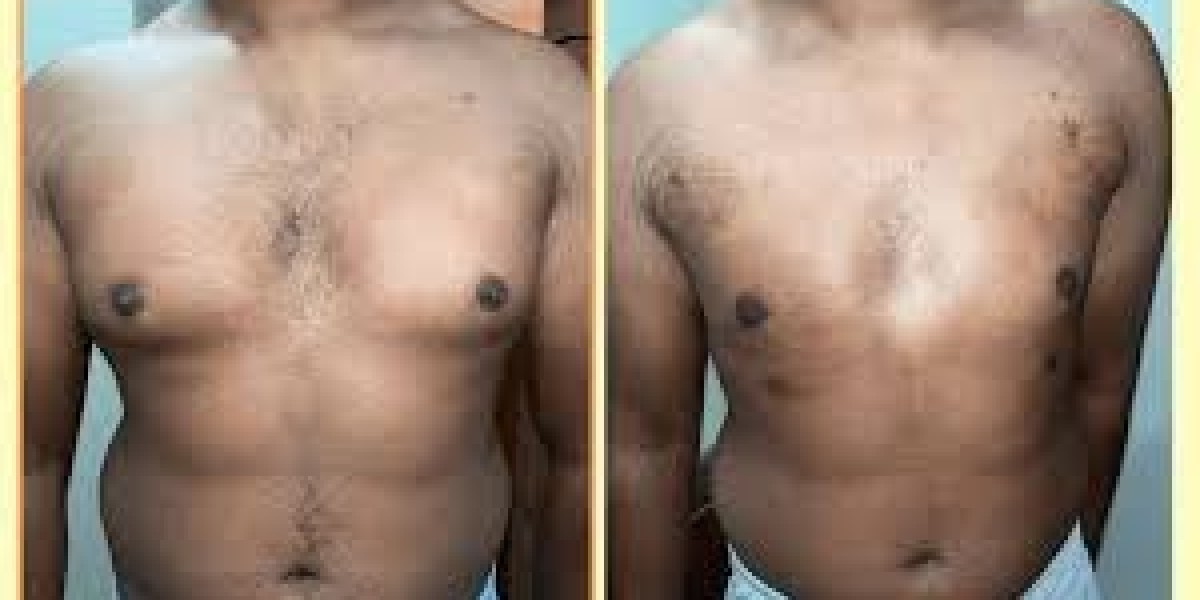 Understanding Gynecomastia vs Fat and Gynecomastia Surgery Cost in India