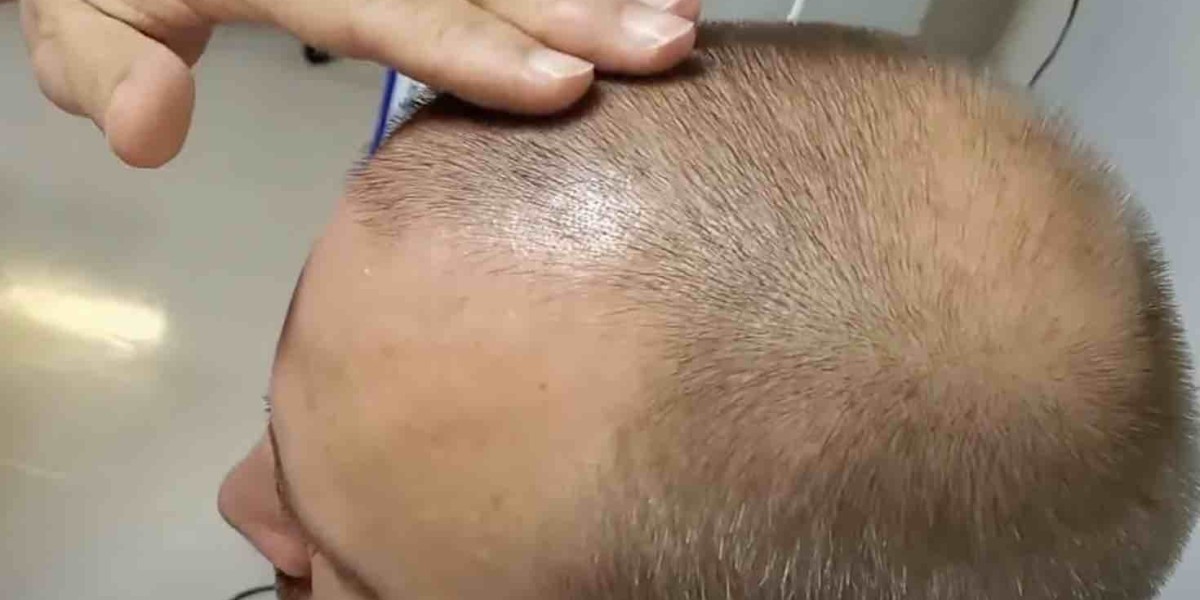 What Is FUT Hair Transplant and How Does It Work?