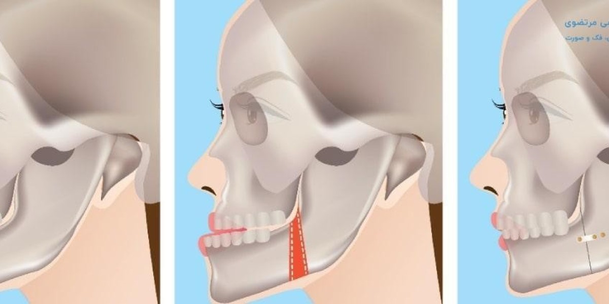 The True Cost of Jaw Surgery and Factors That Affect the Final Treatment Price