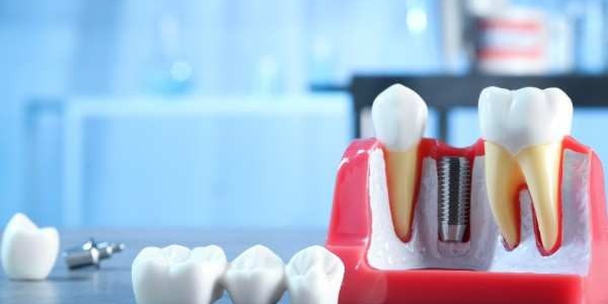 Implant Dentistry That Supports Long-Term Oral Health in Bognor Regis