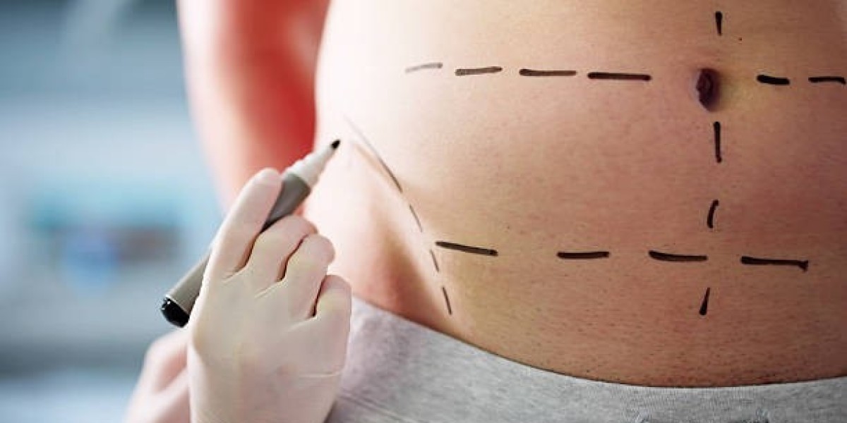 Liposuction in Riyadh: How to Spot a Reliable Surgeon