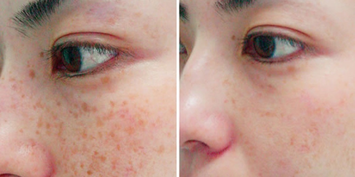Laser For Melasma Daytona Beach