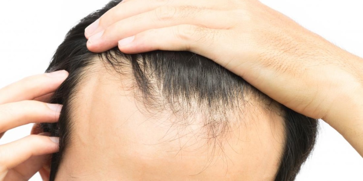 Easy Hairline Fix: Front Line Method