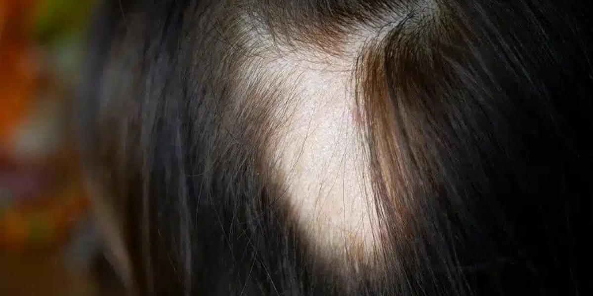 Can Scalp Micropigmentation Cover Alopecia Spots?
