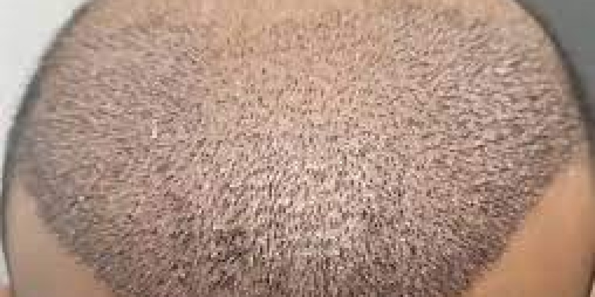 What Affects PRP Hair Treatment Costs in Dubai UAE At Glamorous Clinic ?