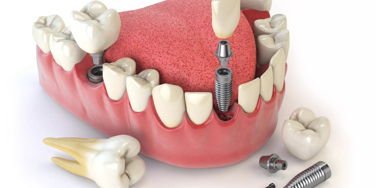 Dental Implants Dubai for Natural-Looking Teeth Every Day