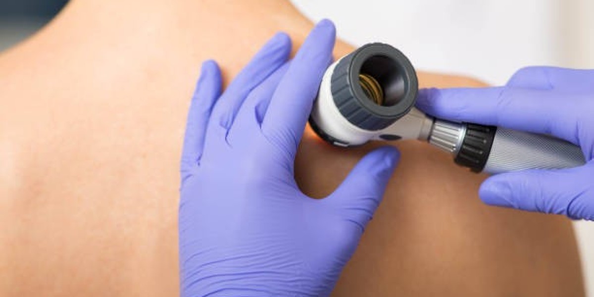 Does Dermoscopy Help Identify Melanoma?