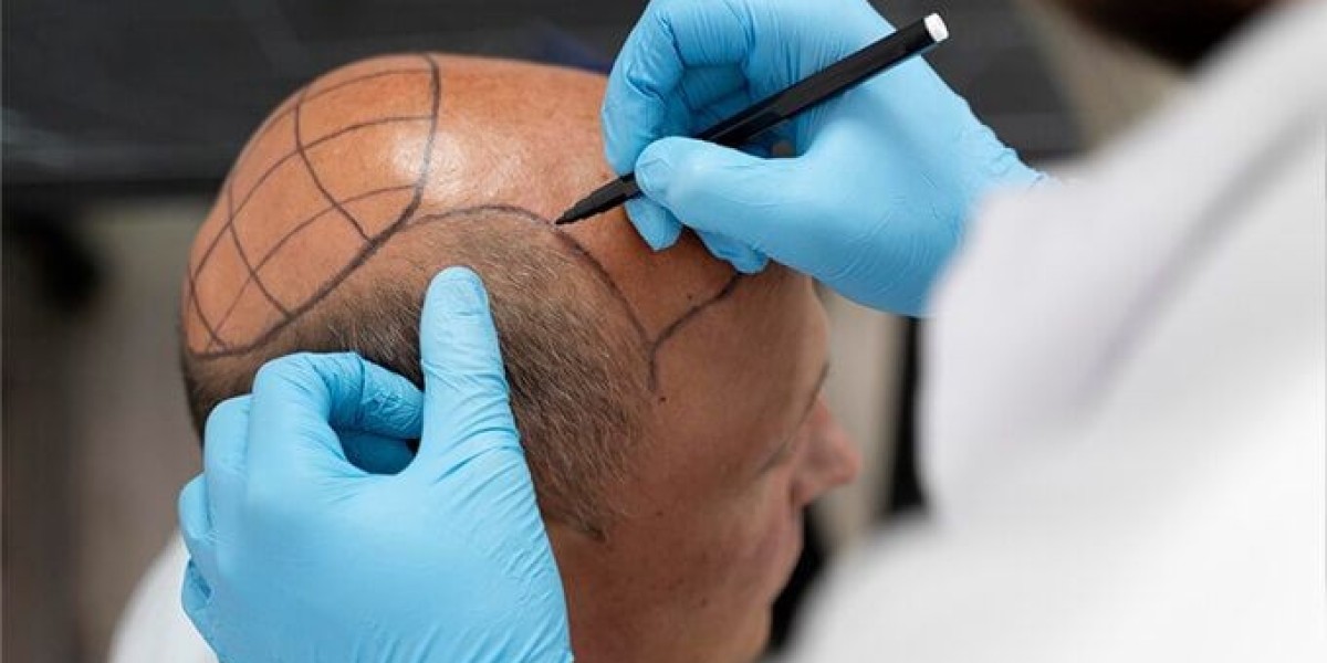 Trusted Hair Grafting Riyadh
