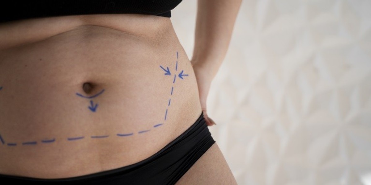 The Impact of Tummy Tuck Surgery in Riyadh on Your Lifestyle