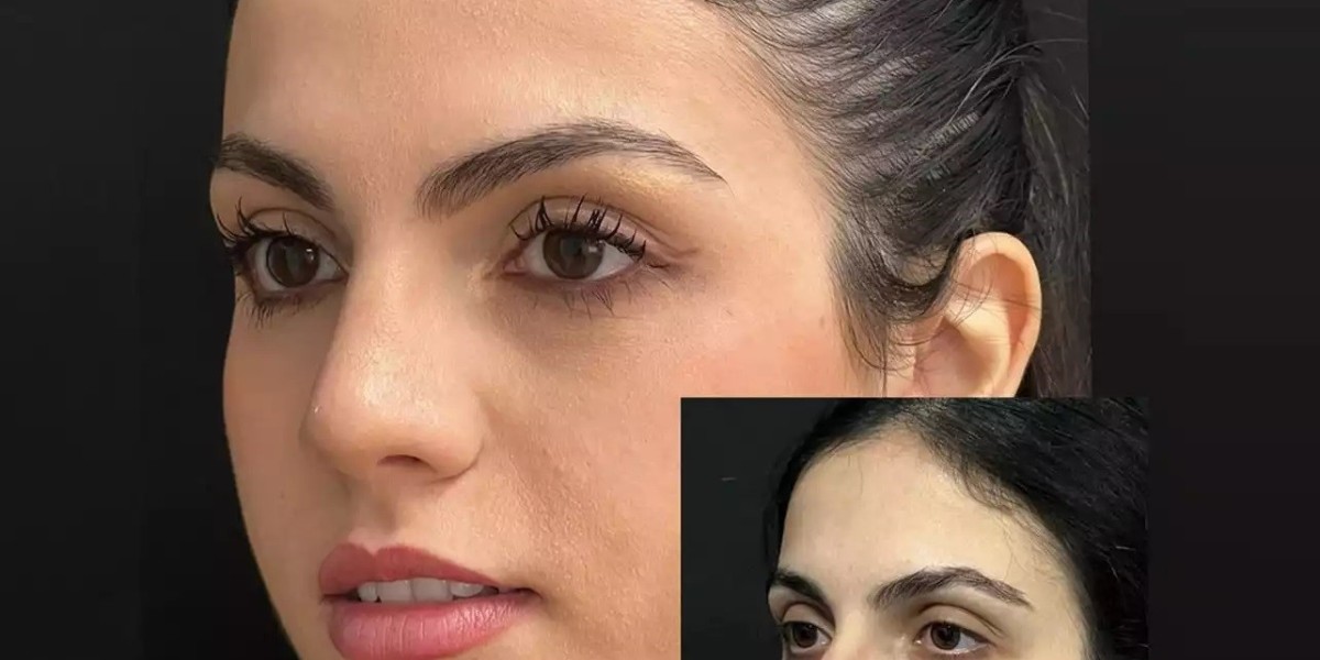 Combining Rhinoplasty with Chin Augmentation for Balanced Features