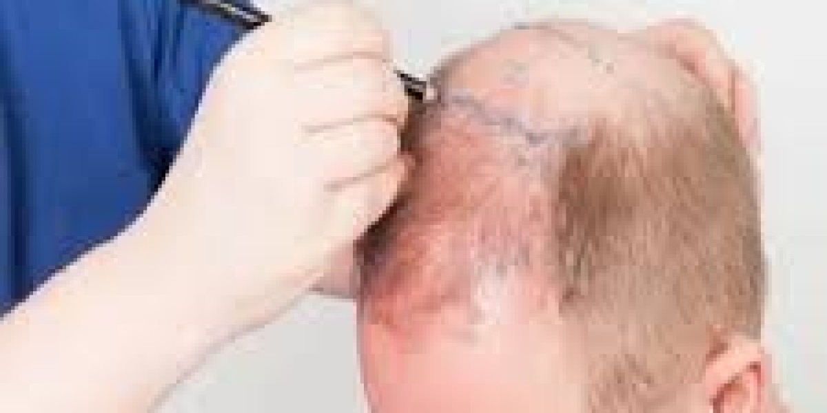 Does FUE Provide Scar-Free Results in Dubai Clinics : Glamorous Clinic UAE ?