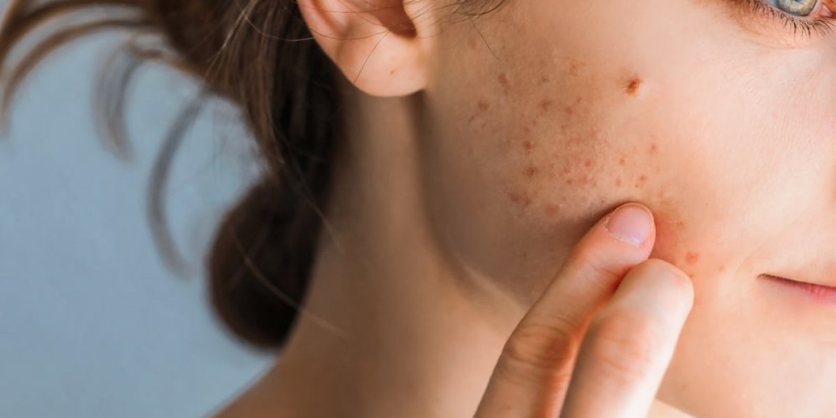 Do Skin Toning Procedures Help Improve Acne Scars?