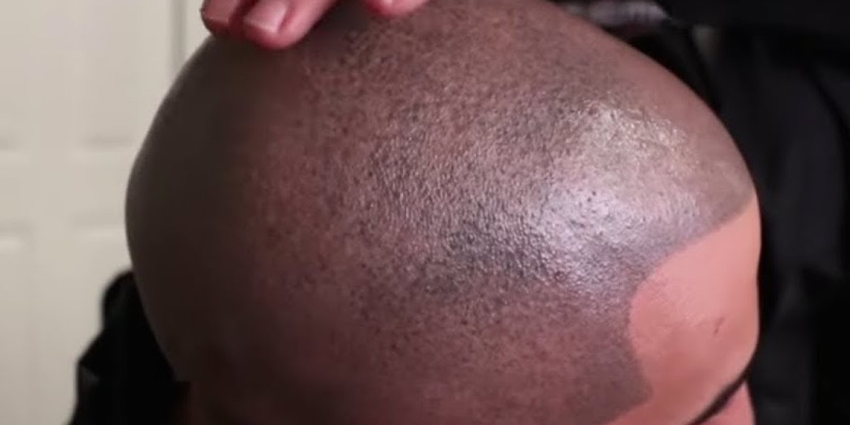 Is Scalp Micropigmentation Safe for Those With Sensitive Skin?