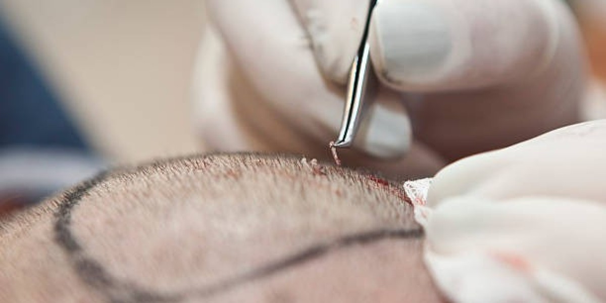 Hair Transplant in Dubai: How Long Does the Procedure Take?