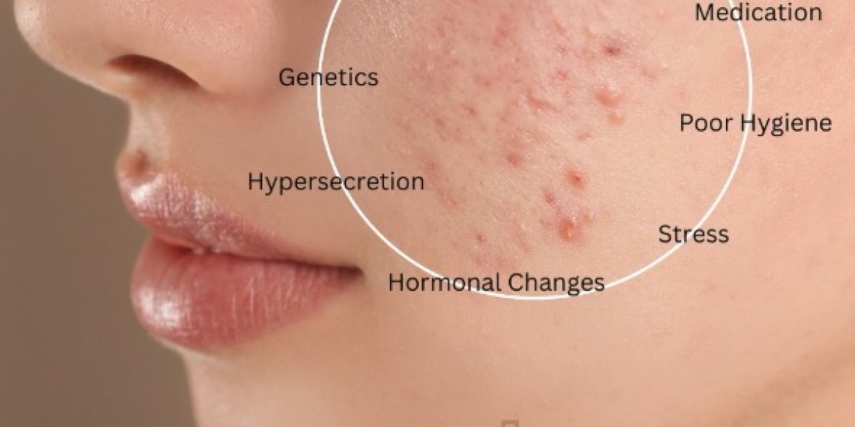 Acne Laser Treatment Toronto: Clearer Skin with Advanced Technology