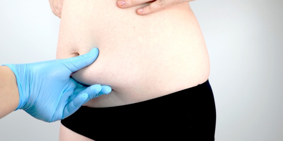 Can a tummy tuck help improve your waistline shape?