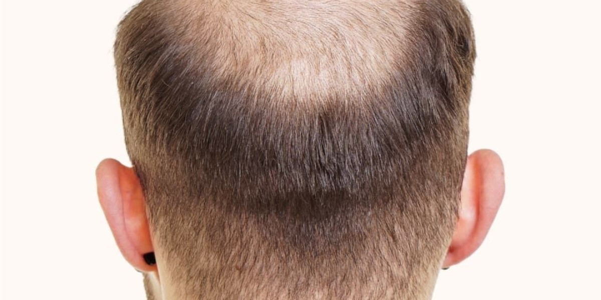 Where to Get Hair Transplant Riyadh