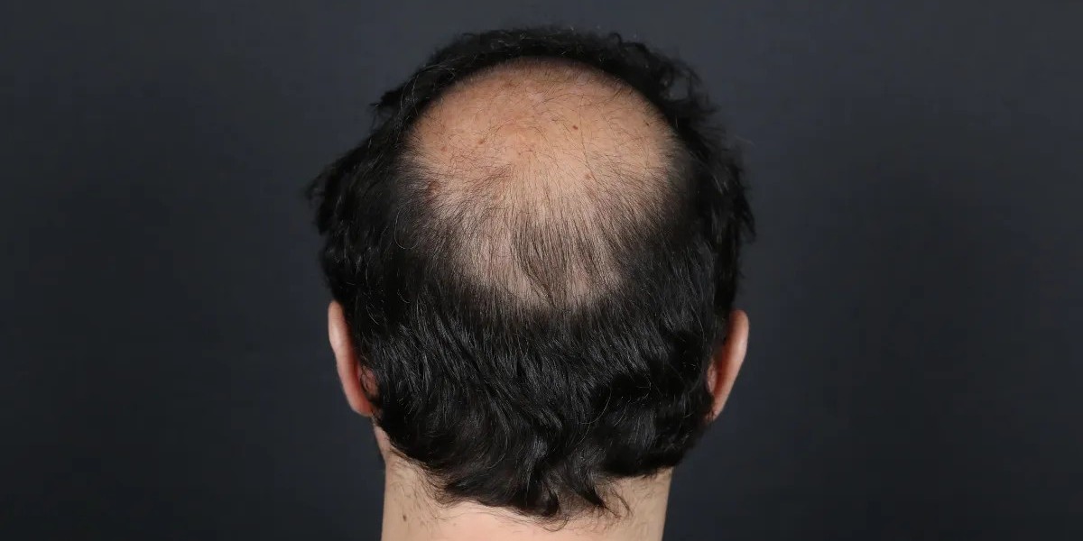 How Effective Is Crown Hair Transplant For Bald Spots?