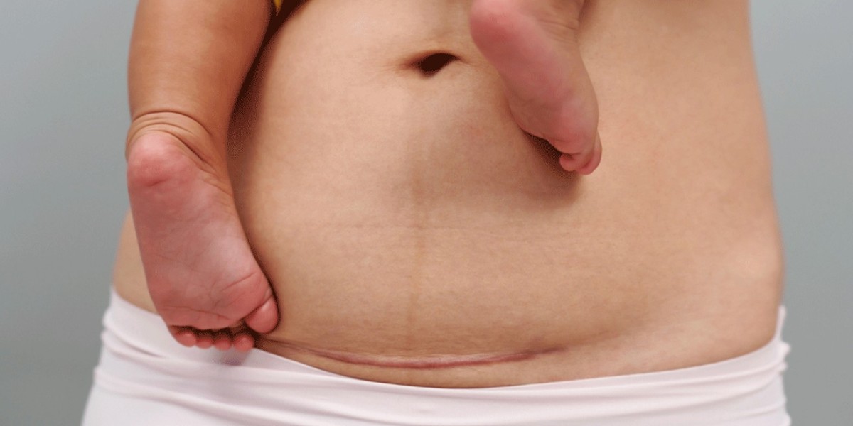 How do tummy tuck scars heal on darker skin tones?