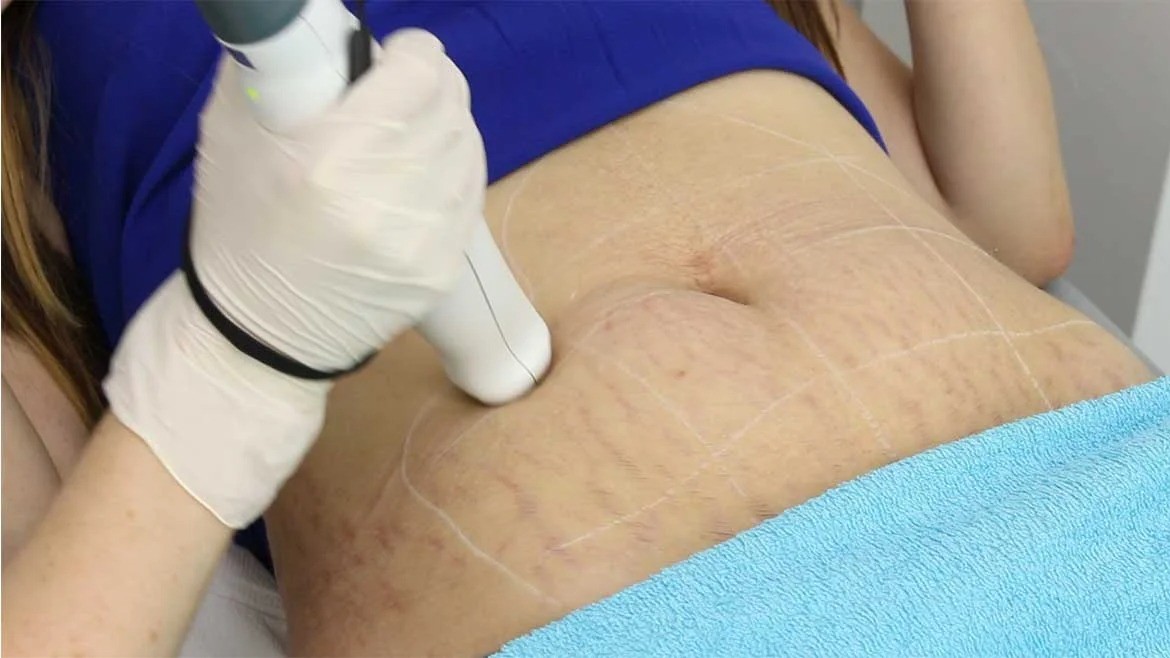 Laser Stretch Marks Treatment