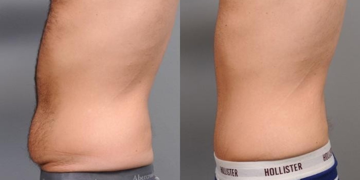 Where to Get Safe Tummy Tuck in Islamabad