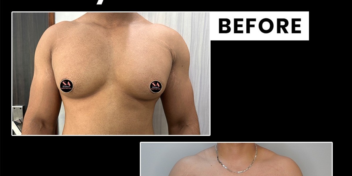 Best Gynecomastia Surgery in Delhi: Meet with an Expert Surgeon