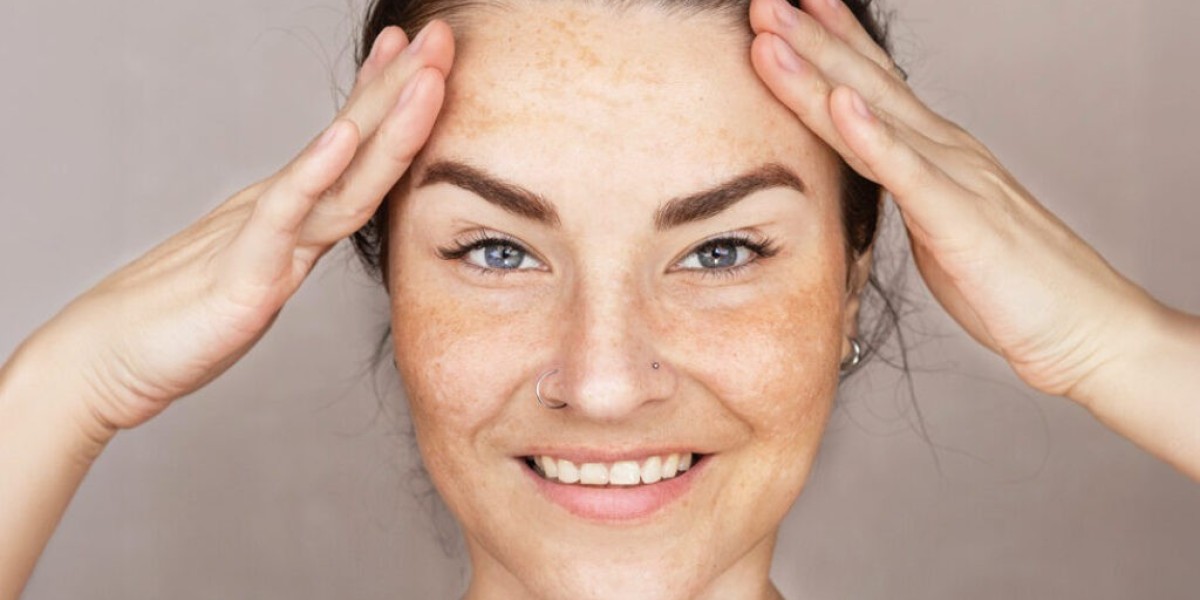 Which Treatment Works Best for Freckles and Blemishes?