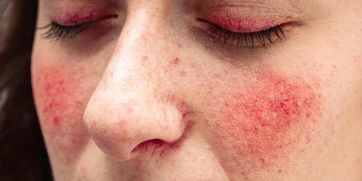 Rosacea Treatment Market Size, Share and Trends Forecast 2025-2033