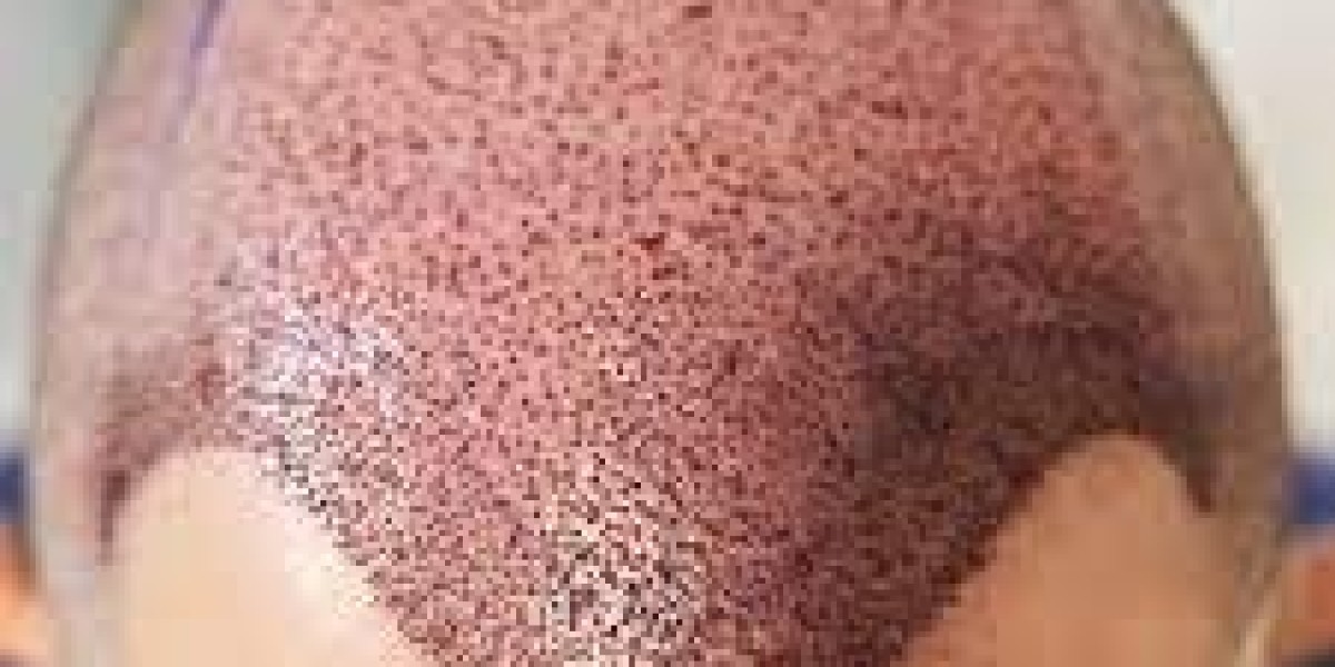 PRP Therapy in Dubai: What You Need to Know