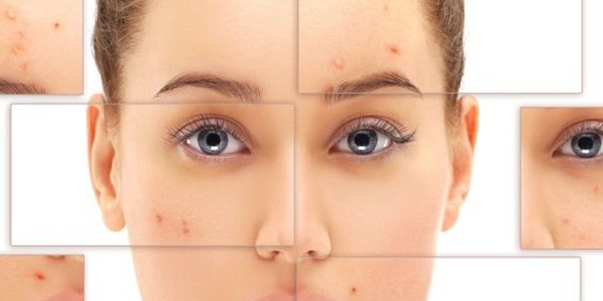 Laser Treatment for Teenage Acne in Islamabad
