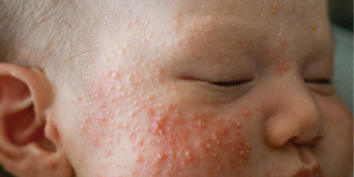 Are Milia Treatments Considered Safe for Children?