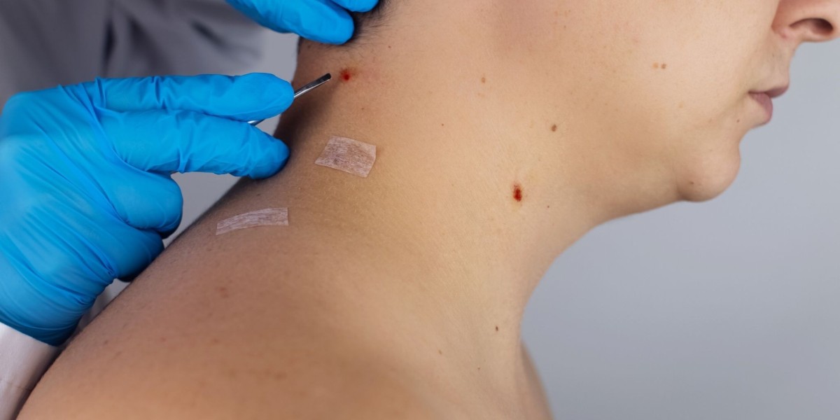 Warts Removal Treatments That Improve Long-Term Skin Health