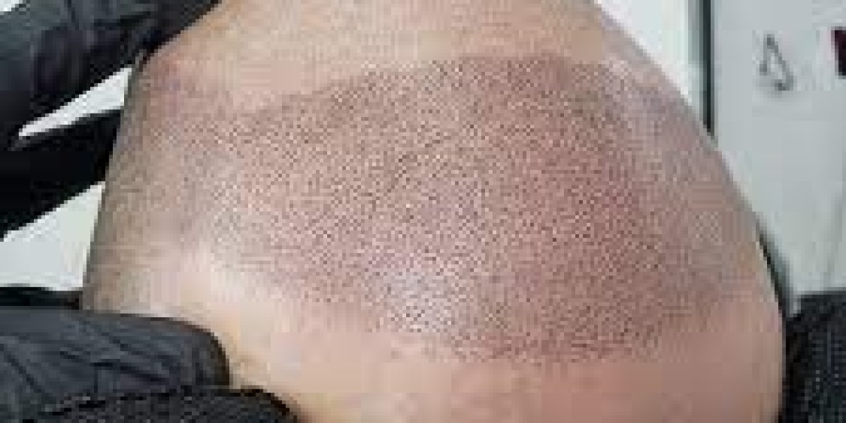 Can Scalp Micropigmentation Work on Gray Hair?