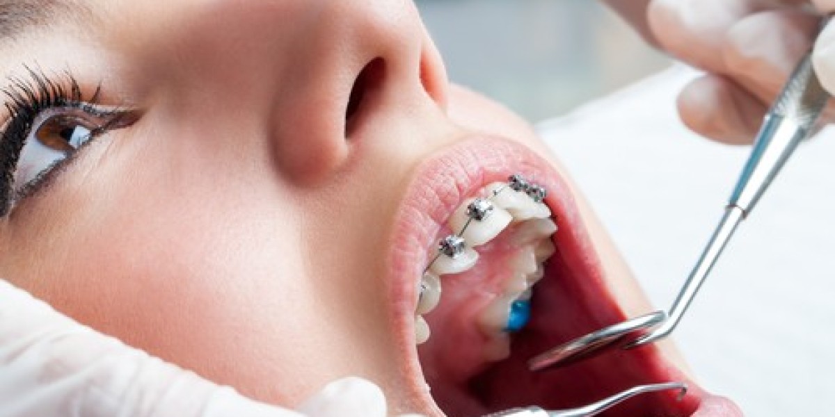 Why Orthodontists Recommend Retainers After Braces