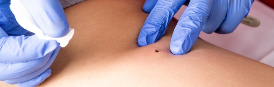 Skin Wart Removal
