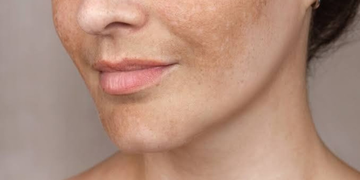 Best Ayurvedic Pigmentation Treatment & Face Cream