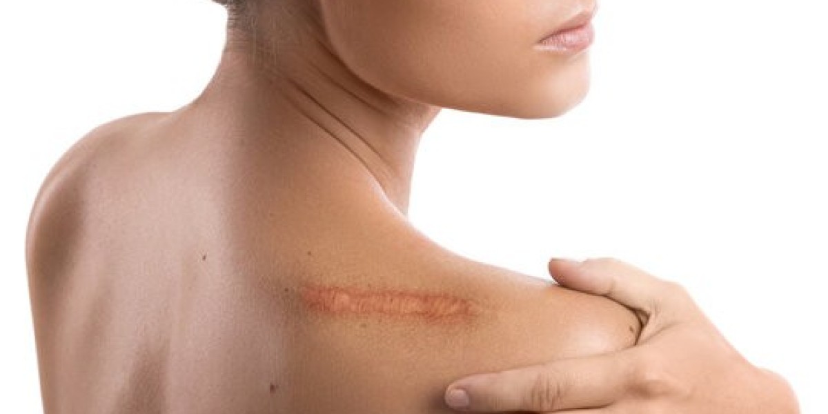 Innovative Methods for Keloid Treatment in Islamabad