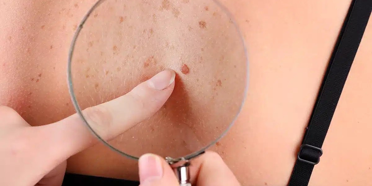 What Are the Common Ways to Remove a Skin Tag?