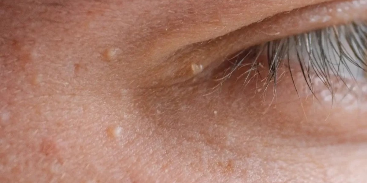 Is Milia Treatment Safe for All Skin Types?